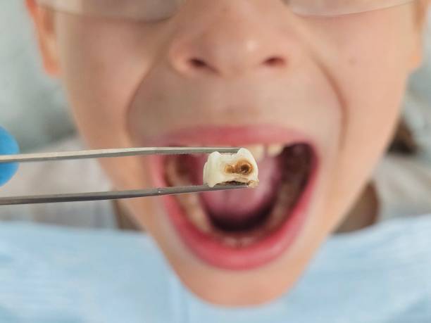 Best Emergency Tooth Extraction in Norton Center, MA